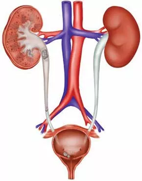 علایم انسداد پیشابراه علایم انسداد پیشابراه