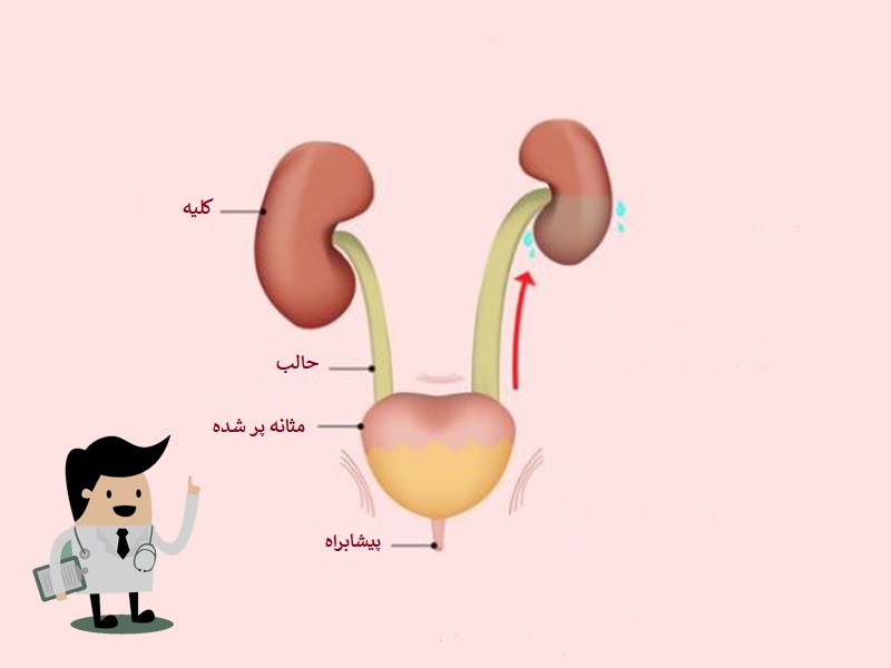 علایم انسداد پیشابراه علایم انسداد پیشابراه